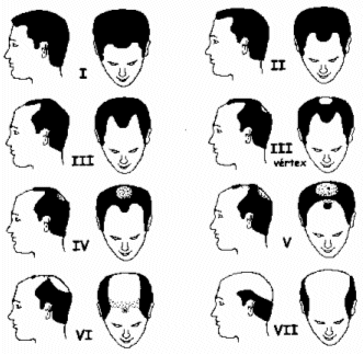 3 clasificaciones principales de alopecia masculina