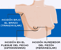 Cirugia mamaria