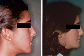 Cirug&iacute;a de ment&oacute;n y p&oacute;mulos (Perfiloplastia) Antes y Despues