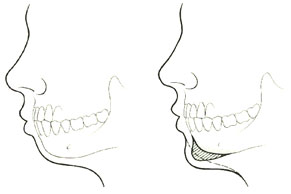 Cirug&iacute;a de ment&oacute;n y p&oacute;mulos (Perfiloplastia) 